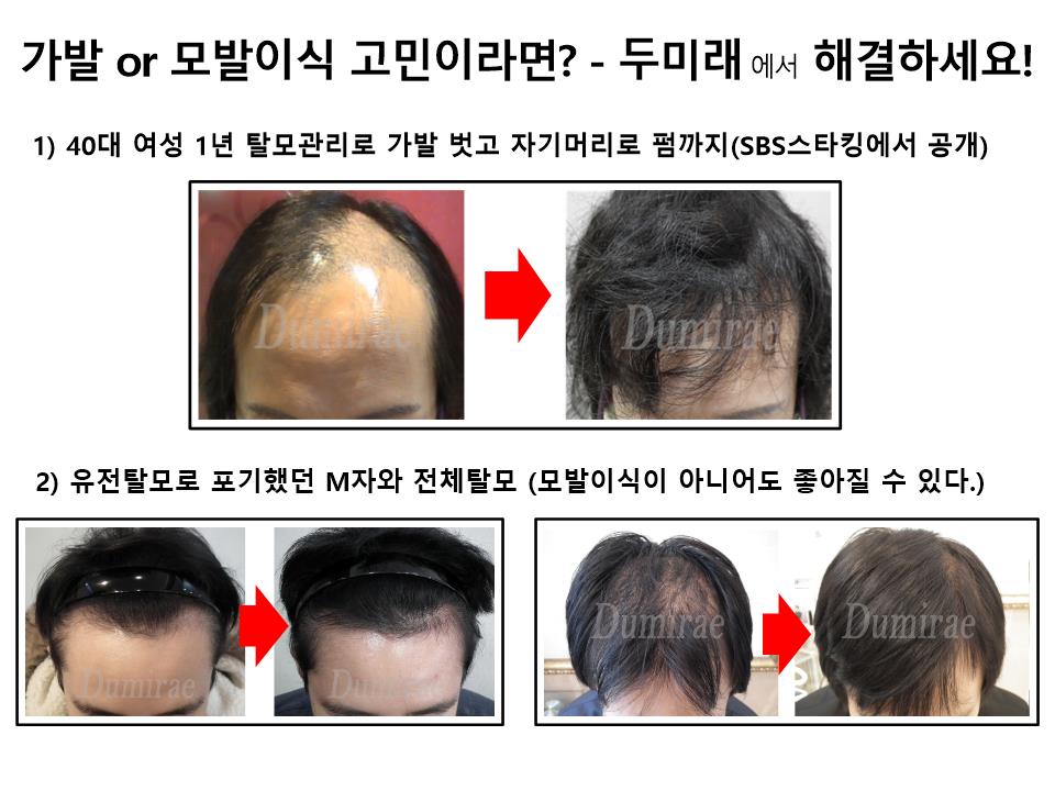 두미래 가발 모발이식 대신 케어
